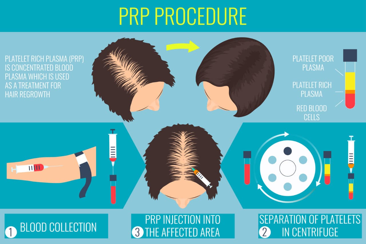 PRP Procedure